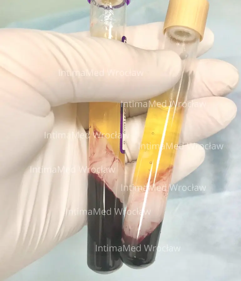 Osocze bogatopłytkowe PRP w probówkach – przygotowanie do zabiegu IntimaMed Wrocław